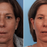 Lower Facelift With Facial Fat Transfer 4
