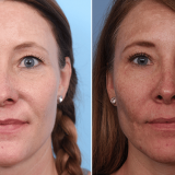 Upper & Lower Blepharoplasty, Mid-Face Fat Transfer And Rhinoplasty 5