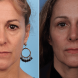 Upper & Lower Blepharoplasty, Facial Fat Transfer, And Rhinoplasty 4