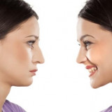 How a Revision Rhinoplasty can Improve Poor Results