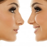 Preparing for Recovery from Rhinoplasty