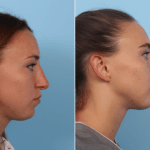 Cote_Denver-Lone-Tree_Rhinoplasty-7-RightLAT