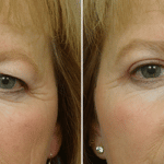 Picerno_Denver-Lone-Tree_Blepharoplasty-2-AP2