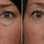 Picerno_Denver-Lone-Tree_Blepharoplasty-3-AP