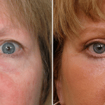 Picerno_Denver-Lone-Tree_Blepharoplasty-4-AP2