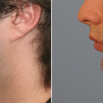 Picerno_Denver-Lone-Tree_Chin-Augmentation-2-LeftLAT