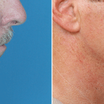 Picerno_Denver-Lone-Tree_Chin-Augmentation-3-RightLAT