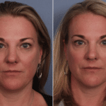 Picerno_Denver-Lone-Tree_Fat-Transfer-1-AP