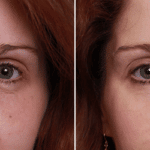 Picerno_Denver-Lone-Tree_Injectable-Fillers-10-AP