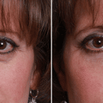 Picerno_Denver-Lone-Tree_Injectable-Fillers-9-AP