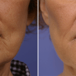 Picerno_Denver-Lone-Tree_Injectable-Fillers-(Juvederm)-4-AP