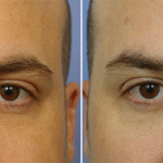 Picerno_Denver-Lone-Tree_Injectable-Fillers-(Juvederm)-5-AP
