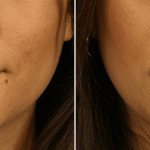 Picerno_Denver-Lone-Tree_Injectable-Fillers-(Juvederm)-6-AP