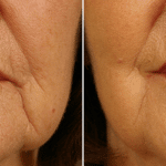 Picerno_Denver-Lone-Tree_Injectable-Fillers-(Juvederm)-7-AP