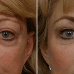 Picerno_Denver-Lone-Tree_Injectable-Fillers-(Restylane)-2-AP