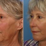 Picerno_Denver-Lone-Tree_Lower-Facelift-Necklift-1-LeftOBL