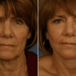 Picerno_Denver-Lone-Tree_Lower-Facelift-Necklift-2-AP