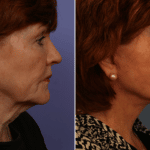 Picerno_Denver-Lone-Tree_Lower-Facelift-Necklift-4-RightLAT