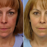Picerno_Denver-Lone-Tree_Lower-Facelift-Necklift-5-AP