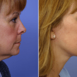 Picerno_Denver-Lone-Tree_Lower-Facelift-Necklift-5-RightLAT