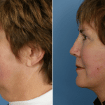Picerno_Denver-Lone-Tree_Lower-Facelift-Necklift-6-LeftLAT
