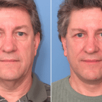 Picerno_Denver-Lone-Tree_Lower-Facelift-Necklift-7-AP