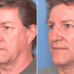 Picerno_Denver-Lone-Tree_Lower-Facelift-Necklift-7-LeftOBL