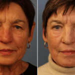 Picerno_Denver-Lone-Tree_Mixto-CO2-Laser-4-AP