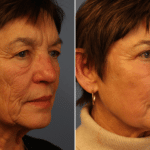 Picerno_Denver-Lone-Tree_Mixto-CO2-Laser-4-RightOBL