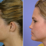 Picerno_Denver-Lone-Tree_Otoplasty-1-LeftLAT