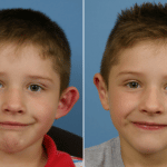 Picerno_Denver-Lone-Tree_Otoplasty-2-AP