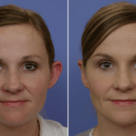 Picerno_Denver-Lone-Tree_Otoplasty-3-AP