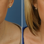 Picerno_Denver-Lone-Tree_Submental-Liposuction-1-AP