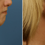Picerno_Denver-Lone-Tree_Submental-Liposuction-1-RightLAT
