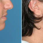 Picerno_Denver-Lone-Tree_Submental-Liposuction-2-RightLAT