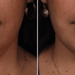 Picerno_Denver-Lone-Tree_Submental-Liposuction-3-AP