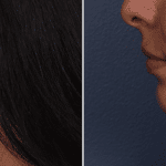 Picerno_Denver-Lone-Tree_Submental-Liposuction-3-LeftLAT