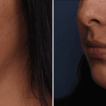 Picerno_Denver-Lone-Tree_Submental-Liposuction-3-LeftOBL