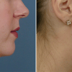 Picerno_Denver-Lone-Tree_Submental-Liposuction-4-RightLAT