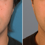Picerno_Denver-Lone-Tree_Submental-Liposuction-5-AP