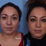 Before-After-Nose-1-1024×756