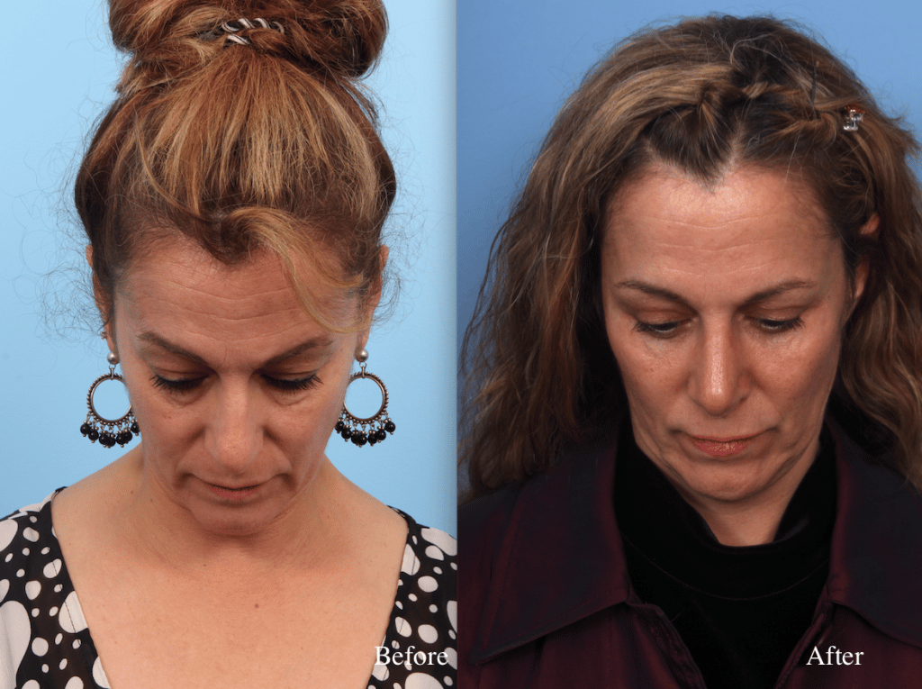 before_after_img