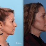 BeforeAfter-3-1024×739