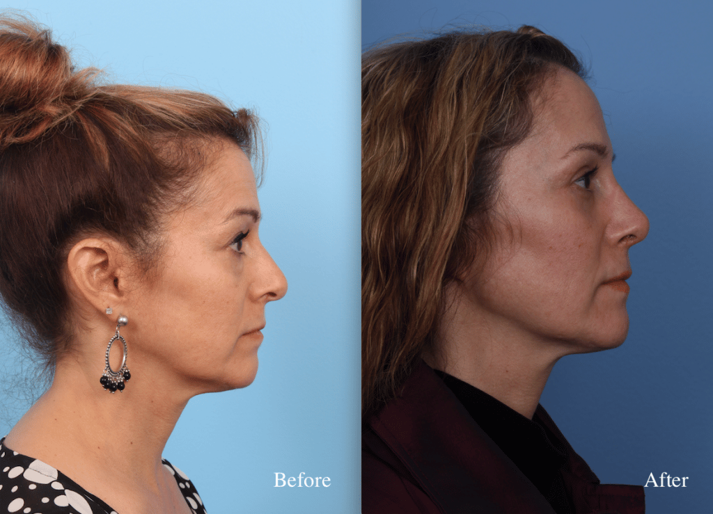 before_after_img