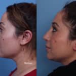 BeforeAfter-Nose-2-1024×752