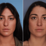 Cote_Denver-Lone-Tree_Rhinoplasty-1-AP