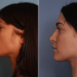 Cote_Denver-Lone-Tree_Rhinoplasty-1-LeftLAT