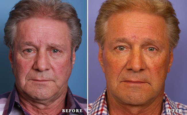 before_after_img