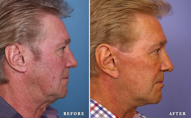 before_after_img