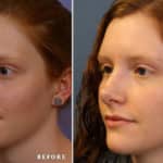FACE-Nose_b1